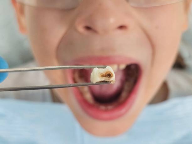 Best Emergency Dentist for Lost Fillings or Crowns in Perry, FL